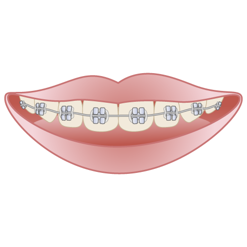 歯列矯正体験談