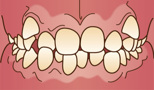 叢生(そうせい)