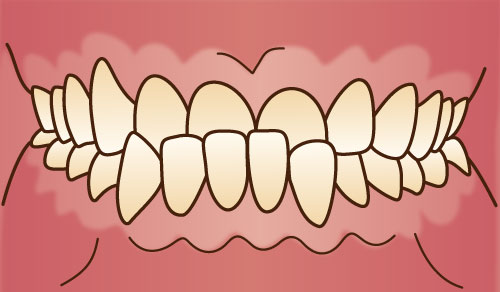 下顎前突(かがくぜんとつ)