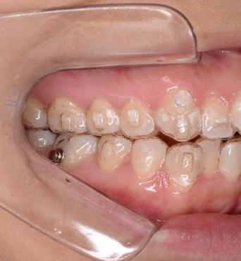 アタッチメントセット