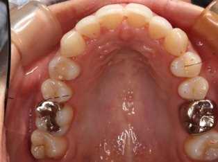 出っ歯、叢生AFTER1