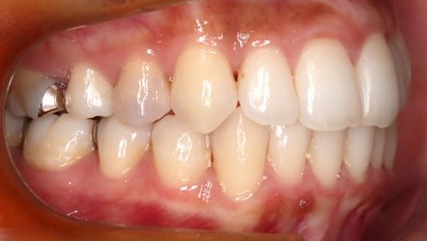 出っ歯、叢生AFTER2