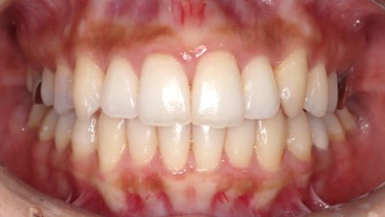 出っ歯、叢生AFTER3