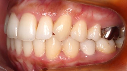 出っ歯、叢生AFTER4