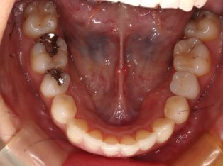出っ歯、叢生AFTER5