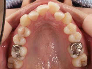 出っ歯、叢生BEFORE1