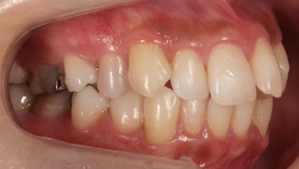 出っ歯、叢生BEFORE2