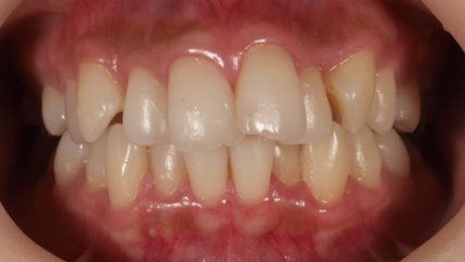 出っ歯、叢生BEFORE3