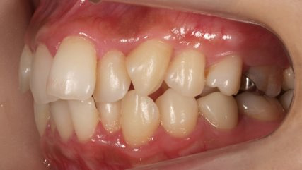 出っ歯、叢生BEFORE4