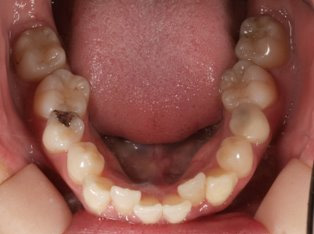 出っ歯、叢生BEFORE5