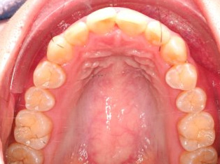 出っ歯、叢生AFTER1