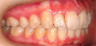 出っ歯、叢生AFTER2