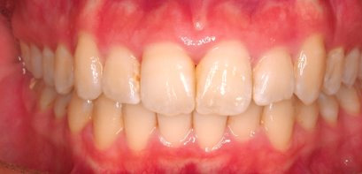 出っ歯、叢生AFTER3