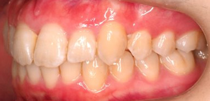 出っ歯、叢生AFTER4
