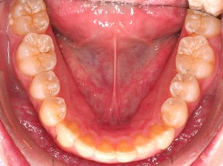 出っ歯、叢生AFTER5