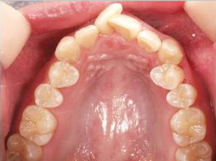 出っ歯、叢生BEFORE1