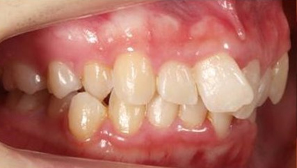 出っ歯、叢生BEFORE2