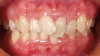 出っ歯、叢生BEFORE3