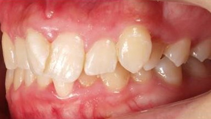 出っ歯、叢生BEFORE4