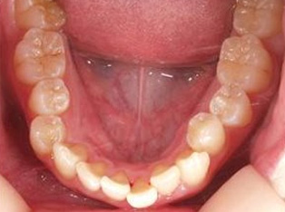 出っ歯、叢生BEFORE5