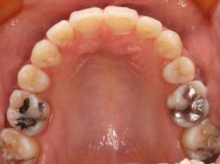 叢生、抜歯矯正治療、側貌改善AFTER1