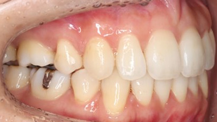 叢生、抜歯矯正治療、側貌改善AFTER2