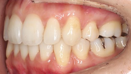 叢生、抜歯矯正治療、側貌改善AFTER4