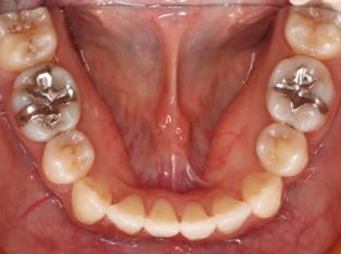 叢生、抜歯矯正治療、側貌改善AFTER5