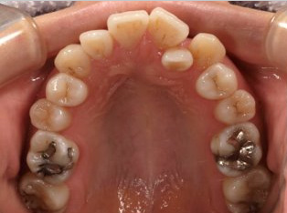 叢生、抜歯矯正治療、側貌改善BEFORE1