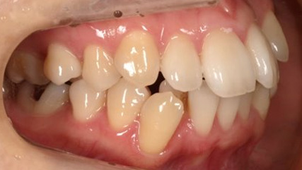 叢生、抜歯矯正治療、側貌改善BEFORE2