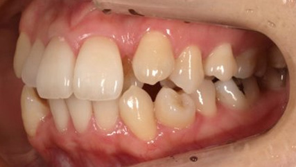 叢生、抜歯矯正治療、側貌改善BEFORE4