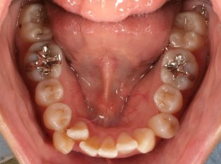 叢生、抜歯矯正治療、側貌改善BEFORE5