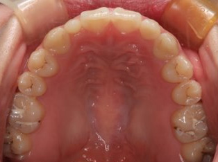 受け口、開咬、カモフラージュ治療AFTER1