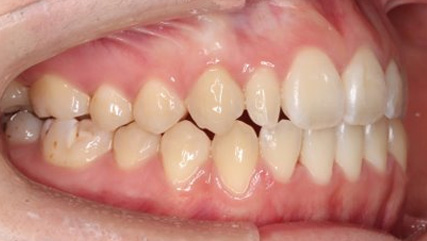 受け口、開咬、カモフラージュ治療AFTER2