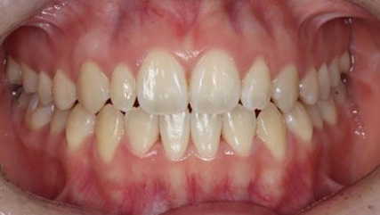 受け口、開咬、カモフラージュ治療AFTER3