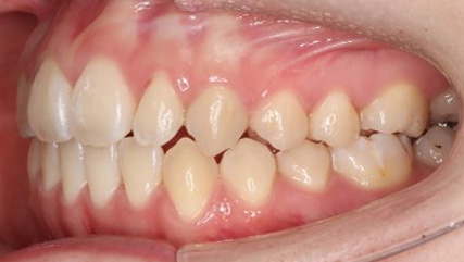 受け口、開咬、カモフラージュ治療AFTER4