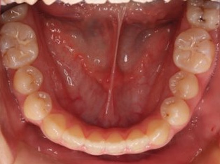 受け口、開咬、カモフラージュ治療AFTER5