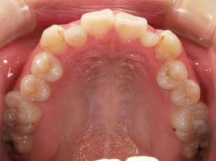 受け口、開咬、カモフラージュ治療BEFORE1