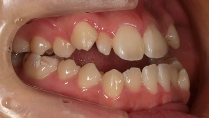 受け口、開咬、カモフラージュ治療BEFORE2