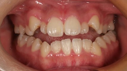 受け口、開咬、カモフラージュ治療BEFORE3