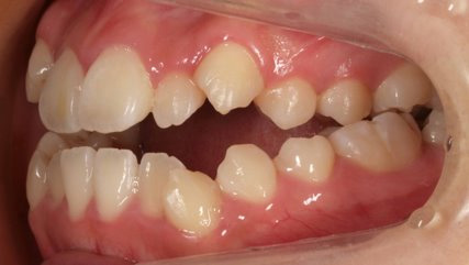 受け口、開咬、カモフラージュ治療BEFORE4