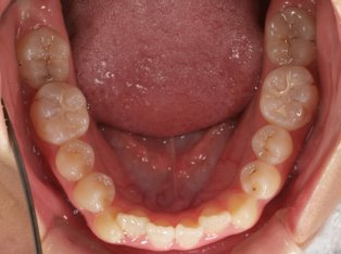 受け口、開咬、カモフラージュ治療BEFORE5