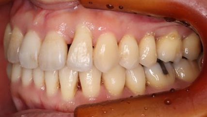 歯周病治療後の矯正治療AFTER4