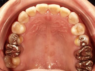 受け口、開咬、デンタルインプラントとのコンビネーション治療AFTER1