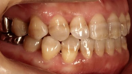 受け口、開咬、デンタルインプラントとのコンビネーション治療AFTER2