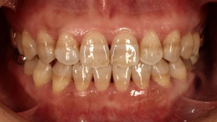 受け口、開咬、デンタルインプラントとのコンビネーション治療AFTER3