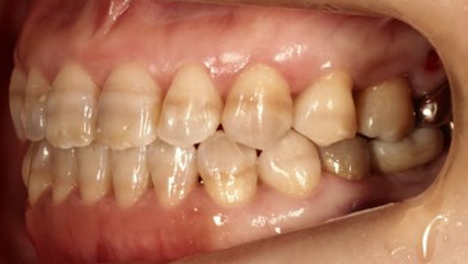 受け口、開咬、デンタルインプラントとのコンビネーション治療AFTER4