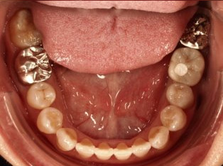 受け口、開咬、デンタルインプラントとのコンビネーション治療AFTER5