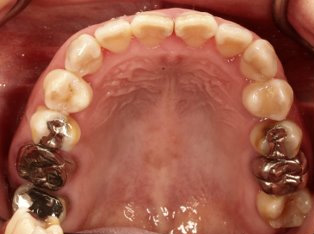 受け口、開咬、デンタルインプラントとのコンビネーション治療BEFORE1