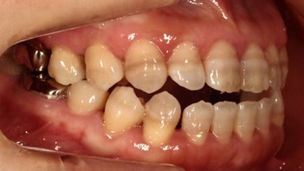 受け口、開咬、デンタルインプラントとのコンビネーション治療BEFORE2